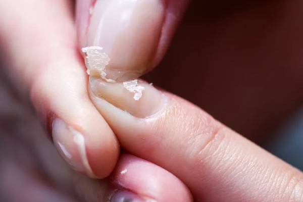 நகம் நொருங்குதா? அப்போ இந்த நோய் உங்களுக்கு இருக்கலாம் | Causes Of Brittle Nails