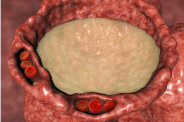 ஈரலில் கெட்ட நீர் தேங்கியிருந்தால் உயிருக்கு ஆபத்து! இந்த  அறிகுறி இருந்தால் உடனே மருத்துவரை நாடுங்கள்