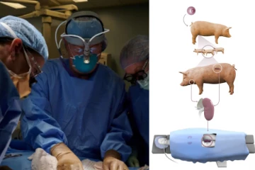 மருத்துவத்தில் மாபெரும் புரட்சி: மனிதனுக்கு பன்றியின் சிறுநீரகம்