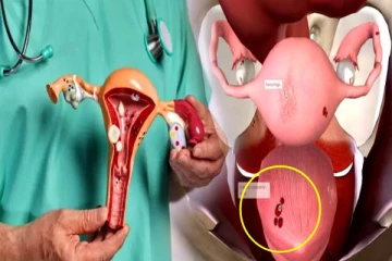 கர்ப்பத்தை தள்ளி வைக்கும் எண்டோமெட்ரியோசிஸ் நோய்- அறிகுறிகளை உடனே தெரிஞ்சிக்கோங்க