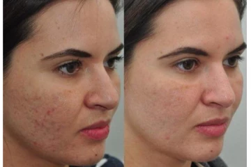 முகத்தில் இருக்கும் குழிகள் என்ன செஞ்சாலும் மறைய மாட்டீங்குதா? ஒரே நாளில் போக்க இந்த ஒரு பொருள் போதும்...!