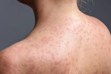 லண்டனில் தீவிரமாக பரவி வரும் தட்டம்மை ; 34 சிறுவர்கள் பாதிப்பு