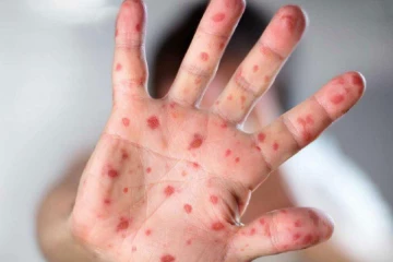 මේ රෝගය කියලා සැක නම් වහාම වාර්තා කරන්න පැතිරීම වළක්වන්න ඇති එකම මඟ එන්නත - සෞඛ්‍ය අංශවලින් විශේෂ දැනුම්දීමක්