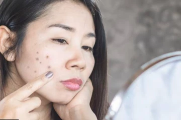 பருக்கள் குறித்து கவலையா? இனி இந்த தொல்லையே இருக்காது..சூப்பரான ஹோம் ரெமடி