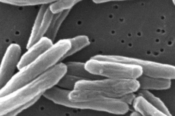 ரொறன்ரோவில் காச நோயாளர் எண்ணிக்கை உயர்வு