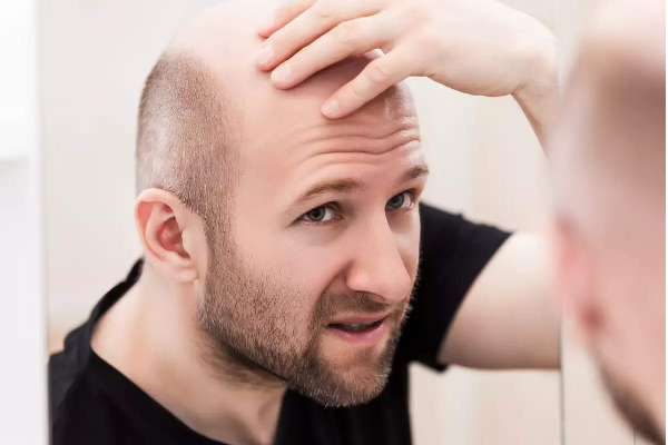 வழுக்கை தலையை கேலி செய்வதும் பாலியல் குற்றம் - ஆண்களுக்கு மகிழ்ச்சியை கொடுத்த தீர்ப்பு - தமிழ்நாடு