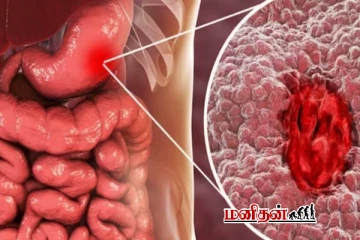 வயிற்று புற்றுநோயின் ஆரம்ப அறிகுறிகள் என்ன? இதை மட்டும் புறக்கணிக்காதீங்க