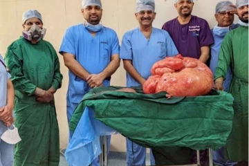 18 ஆண்டுகளாக வலியால் துடிதுடித்த பெண்ணின் வயிற்றுக்குள் 47 கிலோவில் இருந்த கட்டி! வெட்டி எடுத்த மருத்துவர்கள்