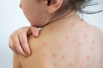 கொழும்பில் பரவும் தட்டம்மை