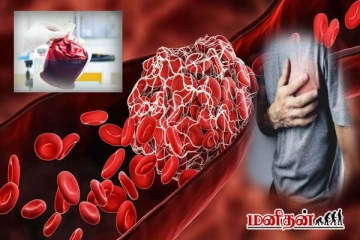 உடலில் இரத்தம் கெட்டியாகினால் முதலில் காட்டும் அறிகுறிகள் எவை?