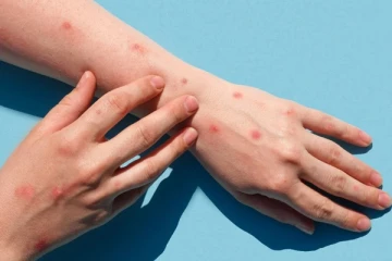 මංකිපොක්ස්' හඳුනාගැනීමේ නිර්ණායක.