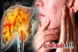 முகத்தில் இந்த அறிகுறி இருக்கா? கல்லீரல் பாதிப்பு உறுதி