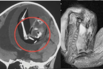 ஒரு வயது குழந்தையின் மூளைக்குள் இன்னொரு குழந்தை! 10 லட்சத்தில் ஒரு முறை நடக்கும் அரிய நிகழ்வு