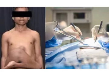 சிறுவன் வயிற்றில் வளர்ந்த 2 கால்கள்.. அறுவை சிகிச்சை மூலம் அகற்றம் - அதிர்ச்சி தகவல்!