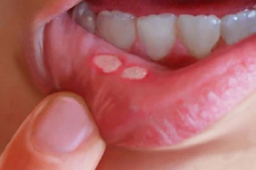 ஒரே நாளில் வாய்ப்புண் சரியாக வேண்டுமா? ஈஸியான டிப்ஸ் இதோ