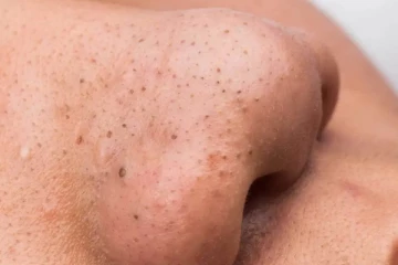 முகத்தில் கருப்புத் தழும்புகள் அசிங்கமாக இருக்கா? இதனை மறைக்க இதோ சில டிப்ஸ்!