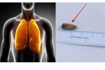 21 ஆண்டுகளாக இளைஞரின் நுரையீரலில் சிக்கியிருந்த பொருள்.. டாக்டர்கள் அதிர்ச்சி - என்ன தெரியுமா?