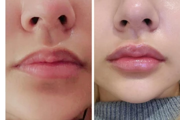 வாயை சுத்தி அசிங்கமா கருப்பா இருக்கா? நொடியில் போக்க இந்த ஒரே ஒரு பொருள் போதும்!