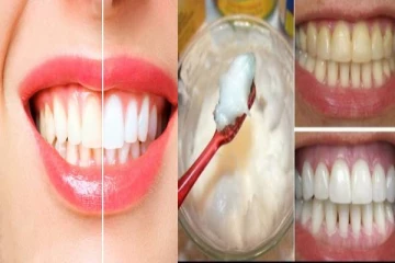 பற்களில் உள்ள அசிங்கமான மஞ்சள் கறையை போக்கணுமா? இந்த வீட்டு வைத்தியம் போதும்