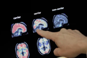 கனடாவில் டிமென்டியா நோயாளர் எண்ணிக்கையில் உயர்வு