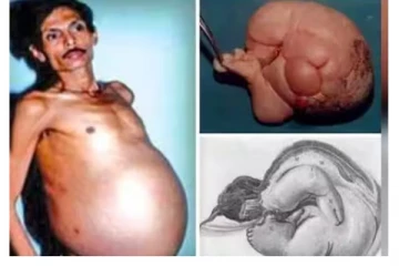 36 வருஷமா வயிற்றில் இரட்டை சிசுவை சுமந்த 60 வயது முதியவர் - ஆடிப்போன மருத்துவர்கள்