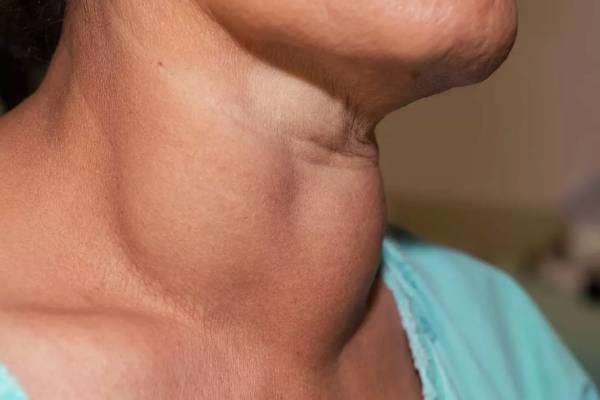 இந்த நோய் இருப்பவர்கள் முள்ளங்கி மறந்தும் சாப்பிடாதீங்க - இந்த விளைவு வரும் | Who Should Not Eat Radishes Health Tips