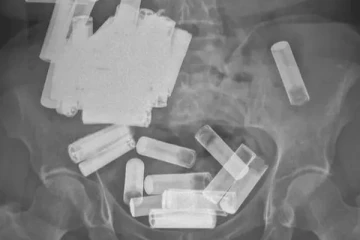 பெண்ணின் வயிற்றுக்குள் எக்ஸ்-ரே எடுத்துப்பார்த்து அரண்டுபோன மருத்துவர்கள்! உள்ளே இருந்த 50-க்கும் மேற்பட்ட பேட்டரிகள்