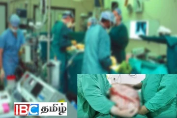 பெண்ணின் கருப்பையிலிருந்து அகற்றப்பட்ட 10 கிலோ கட்டி