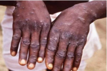 காது, மூக்கு, கண் வழியாக பரவும் குரங்கு அம்மை! அறிகுறிகள் என்னென்ன?