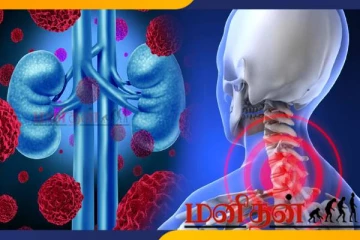 சிறுநீரக புற்றுநோயாளர்களின் கழுத்தில் தெரியும் அறிகுறிகள்