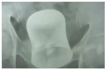 சிகிச்சையில் 55 வயது முதியவர் வயிற்றை கிழித்து பார்த்தபோது... - அதிர்ச்சியில் வாயடைத்த மருத்துவர்கள் - நடந்தது என்ன?