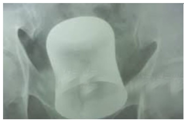 சிகிச்சையில் 55 வயது முதியவர் வயிற்றை கிழித்து பார்த்தபோது... - அதிர்ச்சியில் வாயடைத்த மருத்துவர்கள் - நடந்தது என்ன? - தமிழ்நாடு