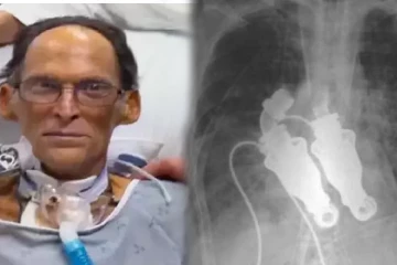 நாடித்துடிப்பே இல்லாமல் உயிர்வாழ்ந்த உலகின் முதல் மனிதர் இவர் தான்!