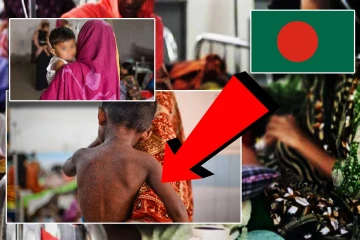 கடுமையான தட்டம்மை நோய் பரவல்: ஆயிரத்திற்கும் மேற்பட்ட குழந்தைகள் உயிரிழப்பு