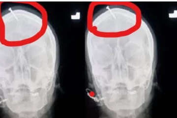 ஆண் குழந்தைக்கு ஆசைப்பட்டு மனைவியின் உச்சந்தலையில் ஆணி அடித்தக் கணவர்