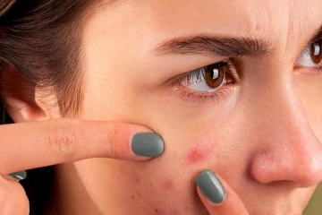 ஒரே இரவில் முகப்பருக்கள் நீங்க வேண்டுமா? இதோ சில எளிய டிப்ஸ்!