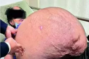 வயிற்றிலிருந்த 47 கிலோ கட்டி அகற்றம் - பாட்டிக்கு ஆபரேஷன் செய்து மருத்துவர்கள் சாதனை