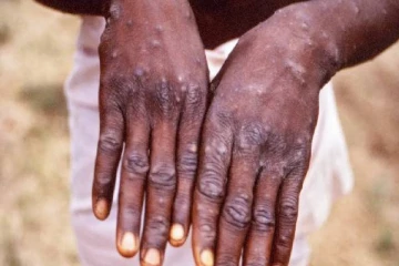 மிரட்டும் குரங்கு அம்மை : வேண்டாம் உடலுறவில் இருந்து தள்ளி இருங்க , எச்சரிக்கும் சுகாதாரத்துறை