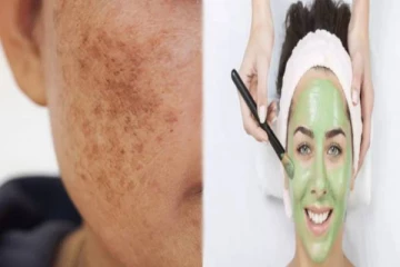 கரும்புள்ளிகளை ஒரே இரவில் அகற்ற வேண்டுமா? அப்போ இந்த பேஸ்பேக்கை பயன்படுத்துங்க