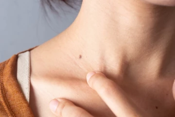 எந்த நிறத்தில் மச்சம் இருந்தால் என்னென்ன பலன்கள் கிடைக்கும்?