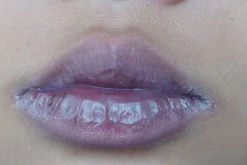 உங்கள் உதடுகள் இப்படி இருக்கா? கொரோனாவின் ஆபத்தான அறிகுறியாம்