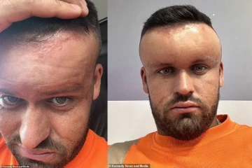 ஹேர்-டையினால் 27 வயது பிரித்தானியருக்கு நேர்ந்த பரிதாபம்! அதிர்ச்சியூட்டும் தோற்றம்