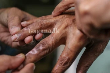 තවත් බෝ වන රෝගයක වර්ධනයක් - වැඩිම පිරිසක් කොළඹින්.. පරිස්සමින් කටයුතු කරන්න..