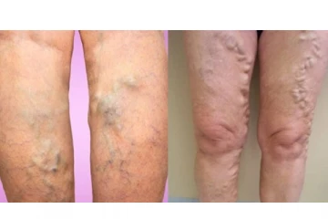 மனிதனை வாட்டியெடுக்கும் வெரிகோஸ் வெயின் நோய் ஏற்பட காரணங்களும், குணப்படுத்த வழிமுறைகளும்