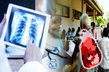 கோவிட் தொற்று பரவலின் பின்னர் மேல் மாகாணத்தில் அதிகரித்து வரும் காச நோயாளர்கள்