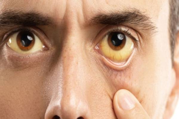 ஆப்பிள் சாப்பிட்டால் மஞ்சள் காமாலை வராதா? வீரியத்தை குறைக்க ஒரு டிப்ஸ் | Jaundice Is Not A Seasonal Disease Daily Habits