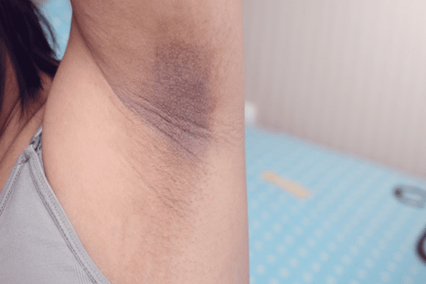 அக்குள் கருப்பா இருக்கா... நொடியில் வெள்ளையாக்க இதை மட்டும் போடுங்க! | Diy Masks To Lighten Your Underarms