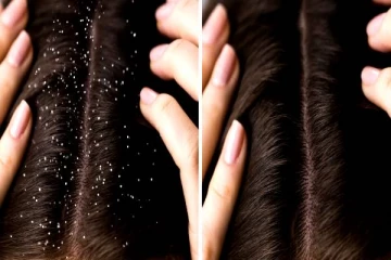 தாங்க முடியாத பொடுகு தொல்லையா? அப்போ நீங்க என்ன செய்யணும் தெரியுமா?