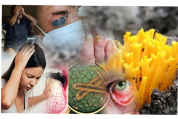 கருப்பு பூஞ்சை, வெள்ளை பூஞ்சை விட அதிக வீரியம் கொண்ட மஞ்சள் பூஞ்சை கண்டுபிடிப்பு - மருத்துவர்கள் எச்சரிக்கை