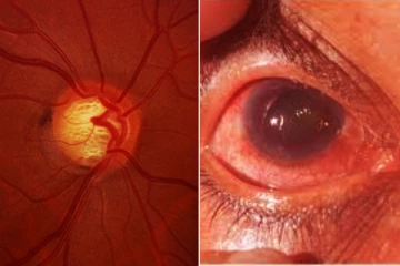 அனைத்து வயதினரையும் தாக்கும் கண்குருட்டு நோய்! மருத்துவர் வழங்கிய ஆலோசனை - காணொலி